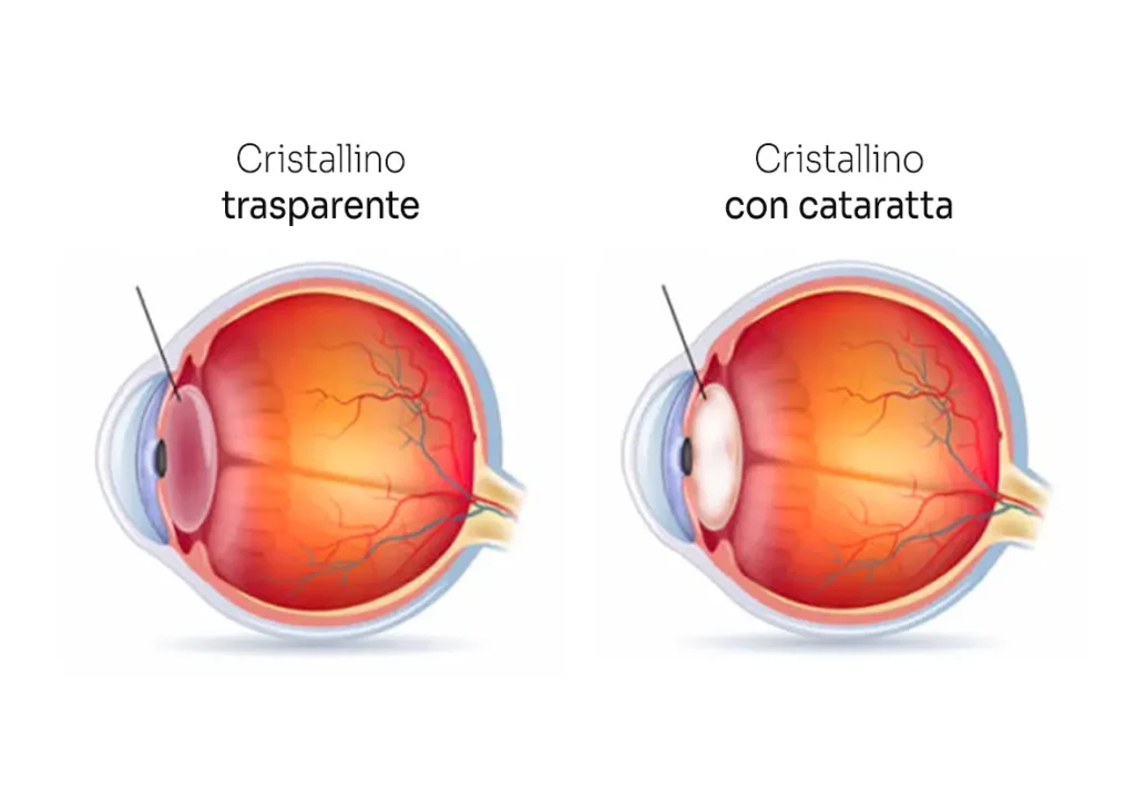 patologia cataratta centro oculistico simi