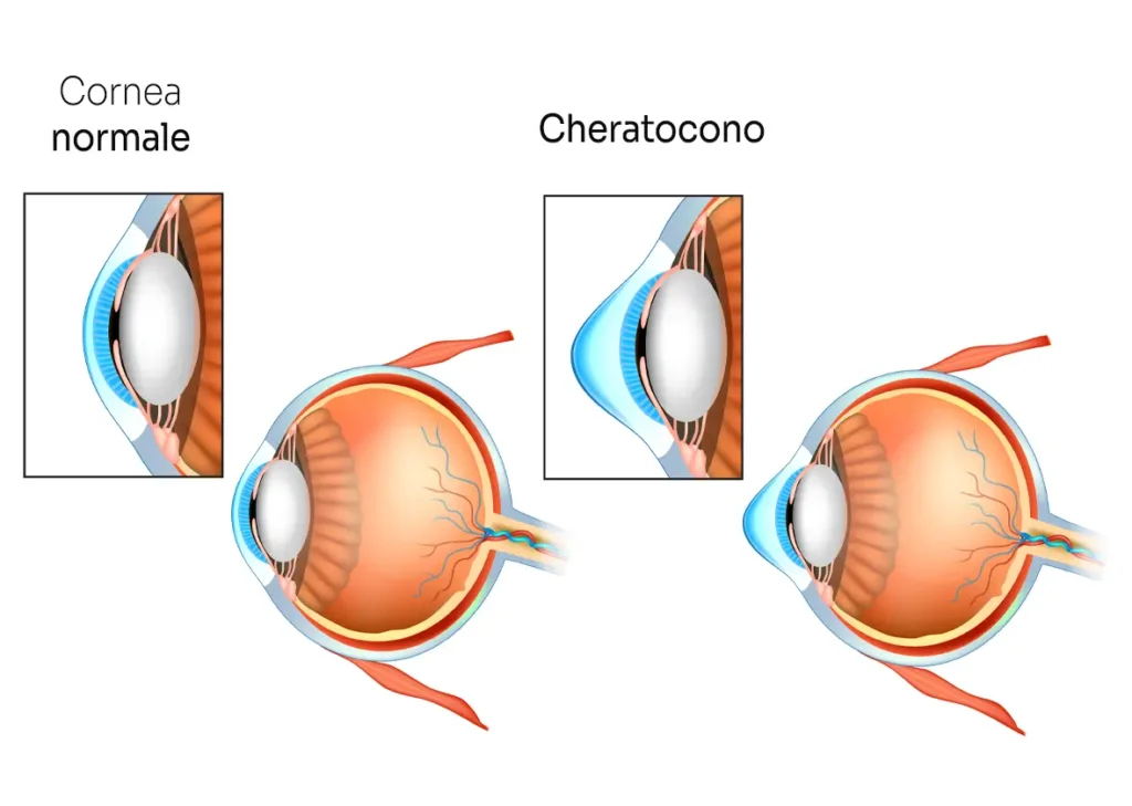 patologia cheratocono centro oculistico simi