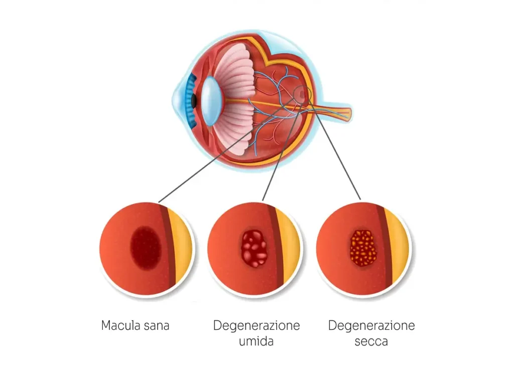 patologia degenerazione maculare senile centro oculistico simi