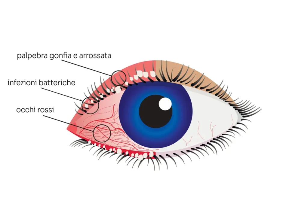 patologia dry eye secchezza oculare centro oculistico simi