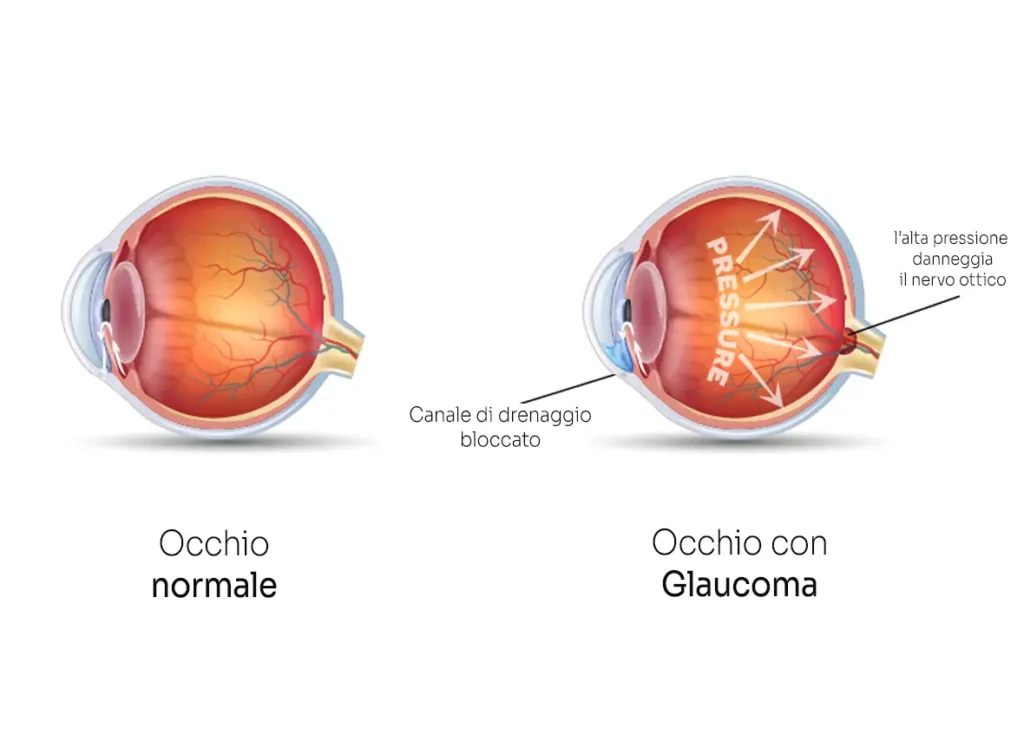 patologia glaucoma centro oculistico simi