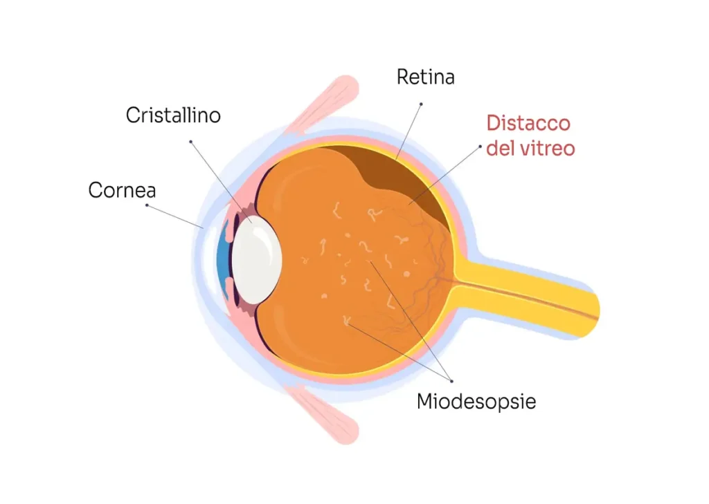 patologia degenerazione posteriore vitreo centro oculistico simi